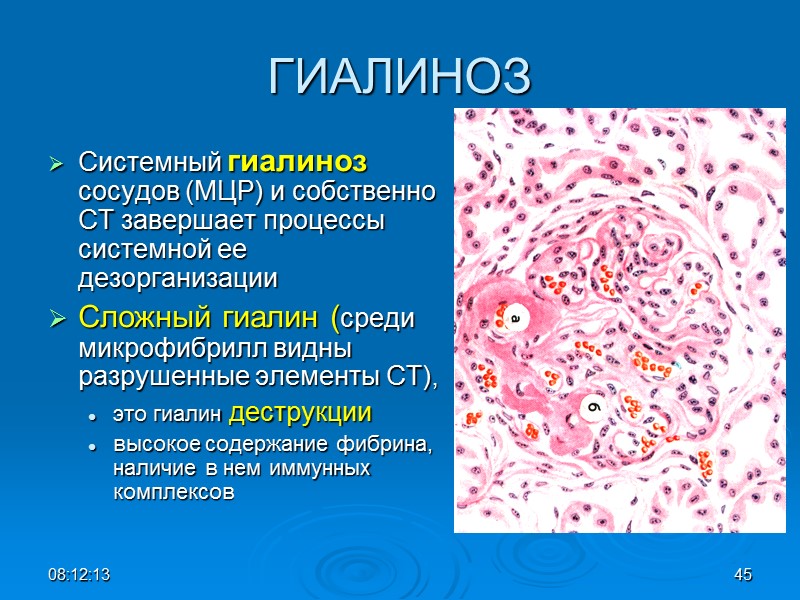 ГИАЛИНОЗ Системный гиалиноз сосудов (МЦР) и собственно СТ завершает процессы системной ее дезорганизации Сложный